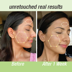 Anti Acne Face Wash