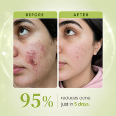 Anti Acne Serum