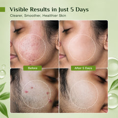 Anti Acne Serum