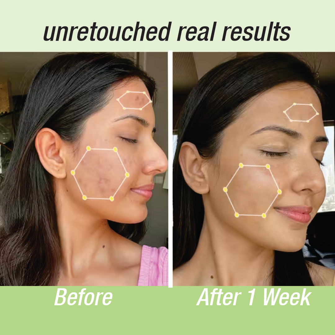 Anti Acne Face Wash