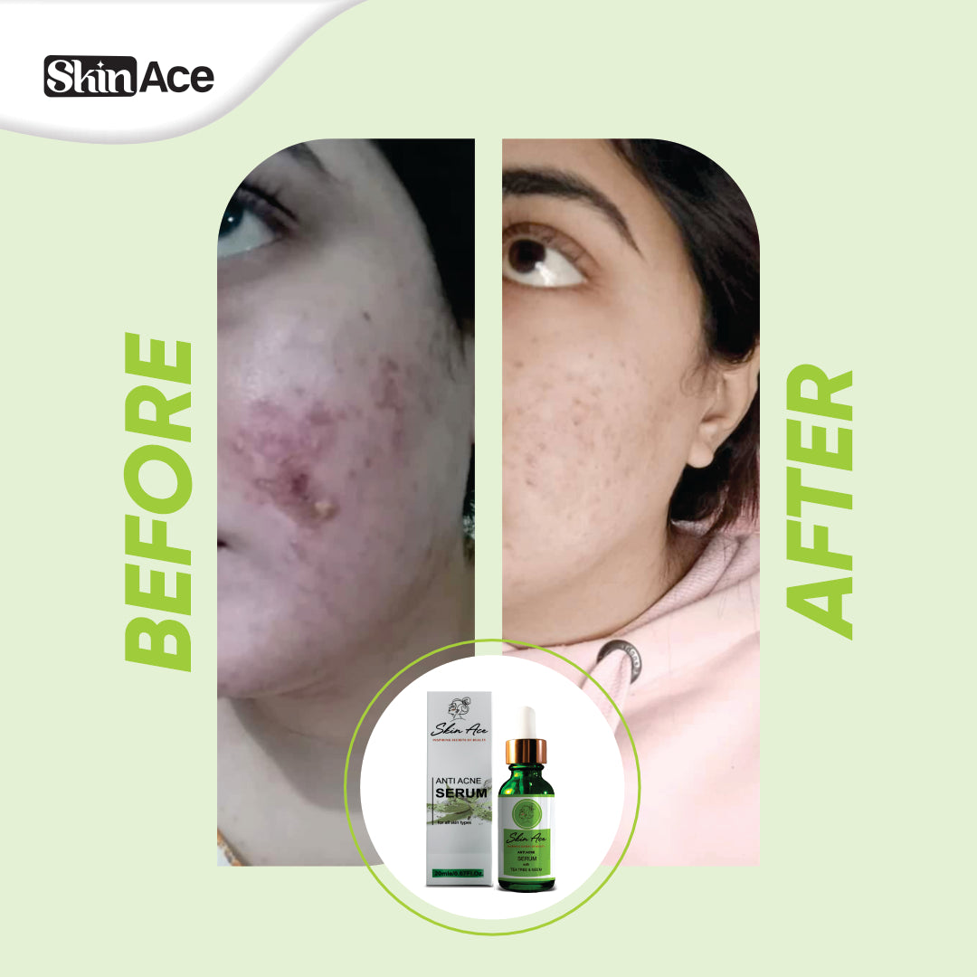 Anti Acne Serum