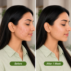 Anti Acne Face Wash