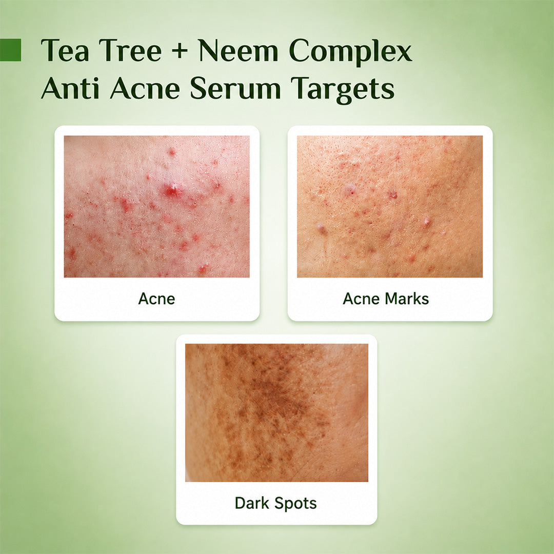 Anti Acne Serum