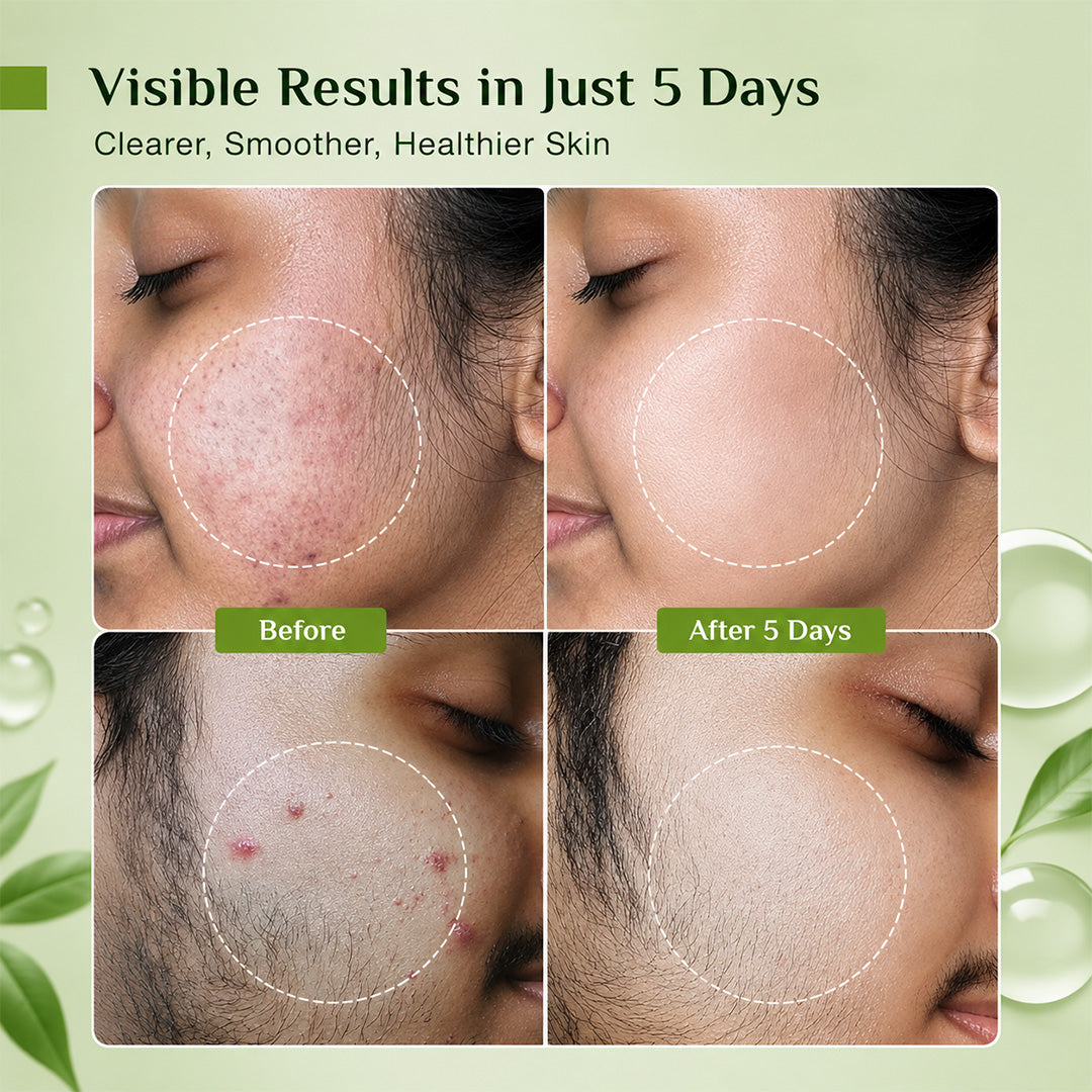 Anti Acne Serum